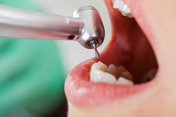 Best Emergency Dentist for Lost Fillings or Crowns in Mount Pleasant, UT